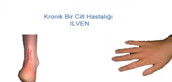 Ilven Hastalığı Nedir?